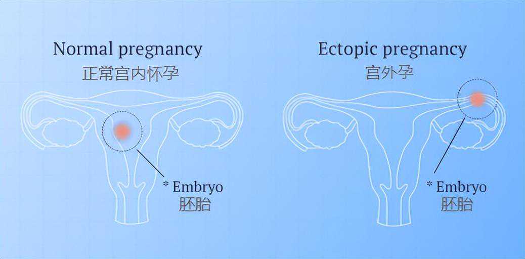 自己去香港验血鉴定性多少钱,失去输卵管后，试管是唯一的捷径